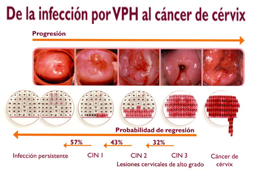 Infección por Virus de Papiloma Humano y Cáncer de Cérvix Joaquín Olmedo